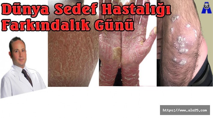 Doç. Dr. Melikoğlu: "Sedef hastalığı bulaşıcı değildir, tedavisi mümkündür"