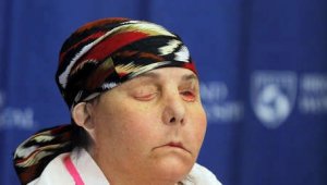 ABD'de iki kez yüz nakli yapılan kadın, ilk kez yeni yüzünü gösterdi