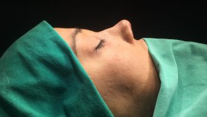 Kaburga kıkırdağından yeni burun ucu