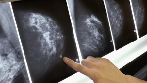 "Dünyada her 5 kişiden biri kansere yakalanıyor"