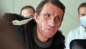 Türkiye'nin ilk yüz nakli 10 yaşında