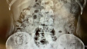 İran'dan gelen 5 kişinin midesinde 6 kilo 145 gram afyon sakızı ele geçirildi